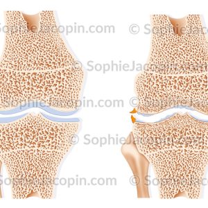 ARTHROSE GENOU