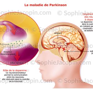 MALADIE DE PARKINSON