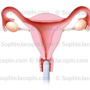 ÉCHOGRAPHIE ENDOVAGINALE