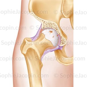ARTHROSE HANCHE