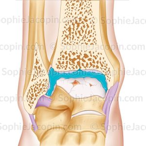 TRAITEMENT ARTHROSE CHEVILLE