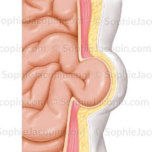 HERNIE ABDOMINALE